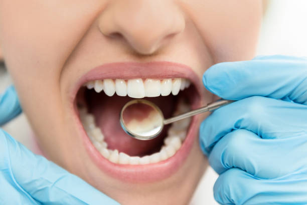 Dental Implants Market by Type (Subperiosteal Implants, Endosteal Implants, and Transosteal Implants), by Material (Titanium, Zirconium Dioxide, and Others), by Design (Tapered Implants and Parallel Walled Implants), by End User (Hospitals, Dental Clinics, and Academic & Research Clinics)– Global Outlook & Forecast 2022-2030