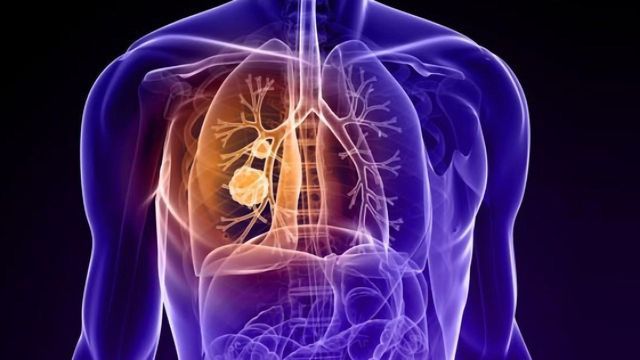 Lung Cancer Therapeutics Market By Disease Type (Small cell Lung Cancer (SCLC), Non-small Cell lung Cancer (NSCLC)), By Treatment Type (Chemotherapy, Immunotherapy, Targeted Therapy) –Global Outlook & Forecast 2022-2030