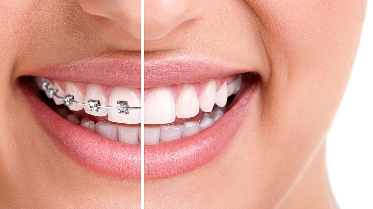 Orthodontics Market by Product (Instruments and Supplies), by End User (Hospital, Dental Clinics, and Others) - Global Outlook & Forecast 2022-2030