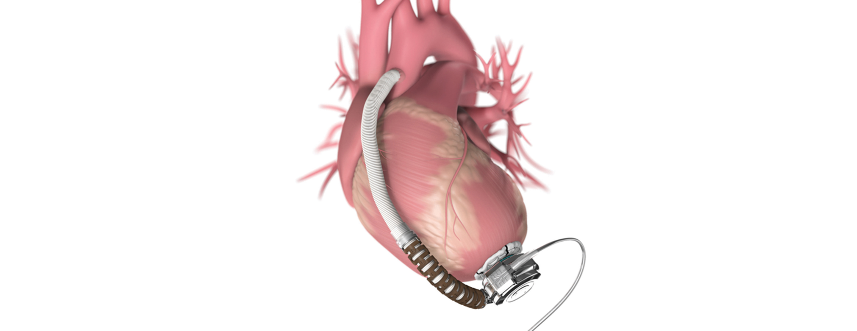 Ventricular Assist Device Market by Product (Right Ventricular Assist Device, Bi-Ventricular Assist Device, Left Ventricular Assist Device, and Total Artificial Heart), by Type (Continuous Flow and Pulsatile Flow), by Application (Destination Therapy, Bridge to Recovery, Bridge to Transplant and Bridge to Candidacy) - Global Outlook & Forecast 2022-2030