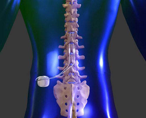 Spinal Cord Stimulation Market By Product (Rechargeable, and Non-Rechargeable), By Application (Degenerative Disk Disease (DDT), Complex Regional Pain Syndrome, Arachnoiditis, Failed Back Syndrome, and Others) - Global Outlook & Forecast 2022-2030