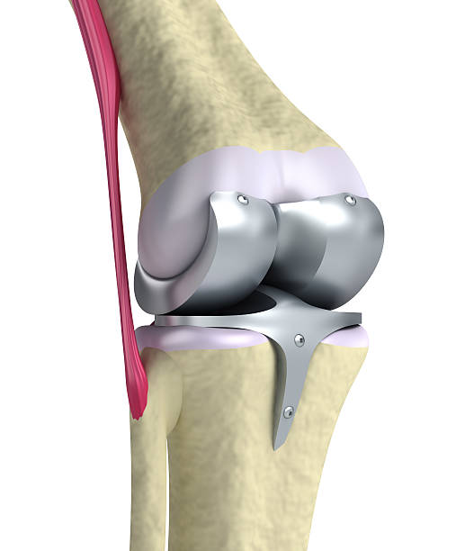 Orthopedic Digit Implants Market by Product Type (Metatarsal Joint Implants, Metacarpal Joint Implants), Material (Pyrocarbon, Titanium), End User (Hospitals & Specialty Orthopedic Clinics) – Global Outlook and Forecast 2020-2030