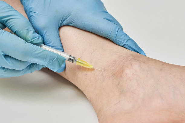 Varicose Veins Treatment Market by Product Type (Compression Devices/Garments, Ablation Devices), Treatment Type (Sclerotherapy, Ligation/Stripping) -Global Outlook & Forecast 2022-2030