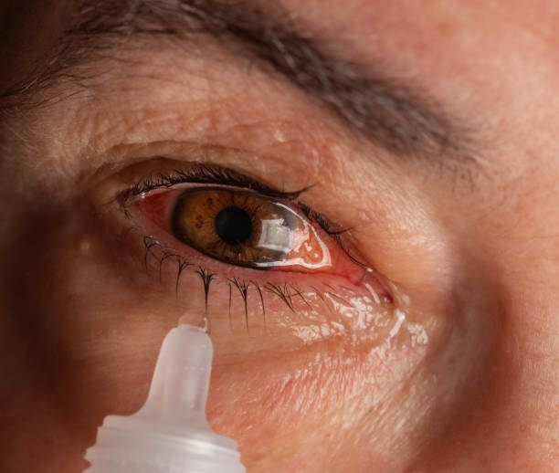 Atopic Keratoconjunctivitis Market by Drug Class (Nonsteroidal Anti-inflammatory Drugs, Corticosteroids), Distribution Channel (Hospital Pharmacies, Retail Pharmacies) - Global Outlook and Forecast 2023-2031