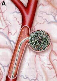 Embolization Coils Market by Type (Detachable Coil, Pushable Coil), Application (Neurology, Cardiology), Material (Platinum, Platinum & Hydrogel) – Global Outlook & Forecast 2023-2031