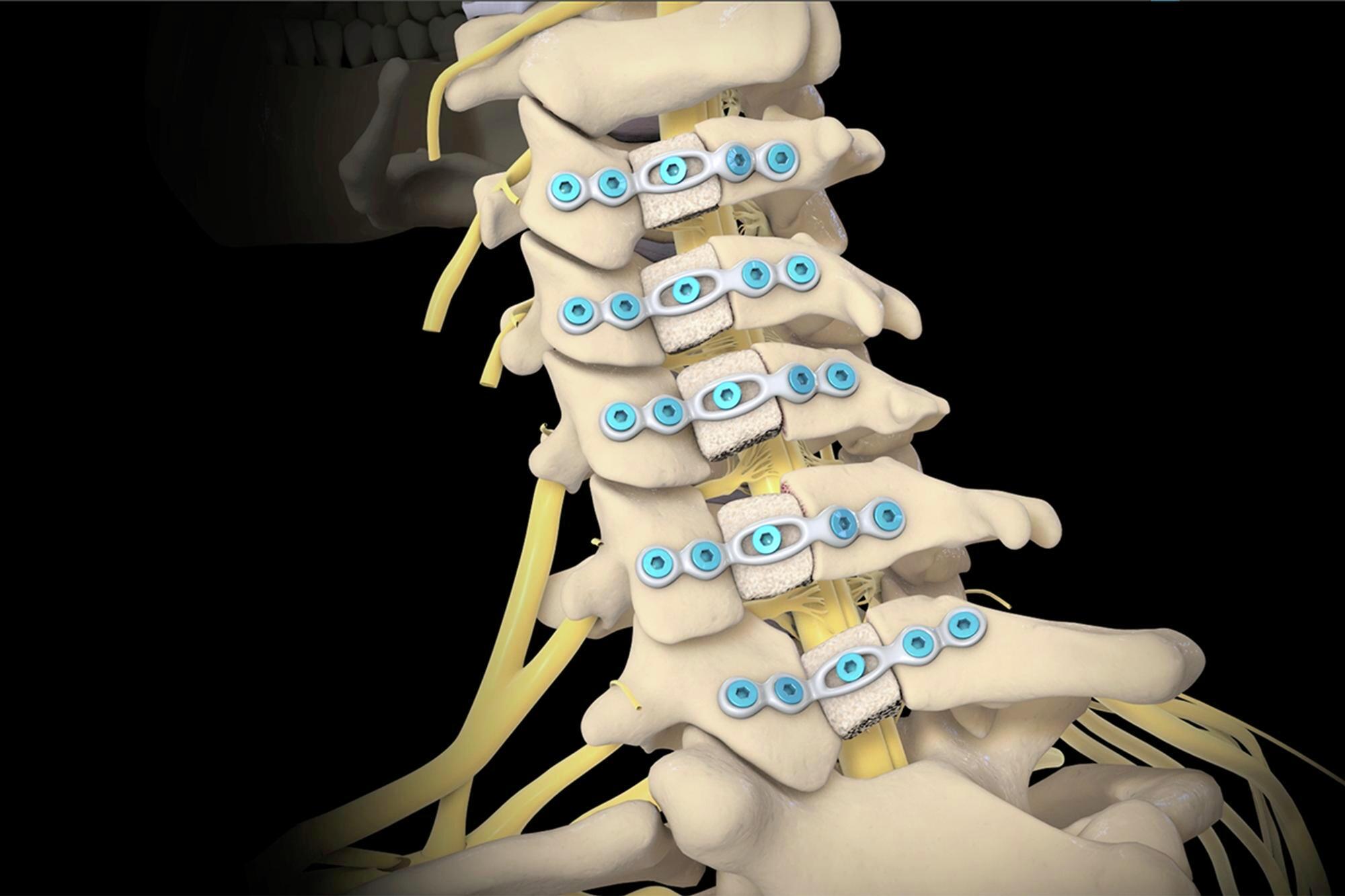 Spinal Laminoplasty Market by Technology (Spine Fusion, Spine Biologics), Vertebral Position (Cervical Laminoplasty, Thoracic Laminoplasty), Surgery Type (Minimally Invasive Surgery, Open Surgery) – Global Outlook & Forecast 2023-2031