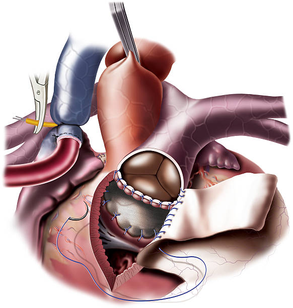 Endovascular Abdominal Aortic Aneurysm Repair Devices Market by Product (Synthetic Fabric Graft, Stent-graft), Age Group (Adult, Pediatric), Material (Metal, Polymer), End User (Hospitals, Research Institutes) - Global Outlook and Forecast 2023-2031