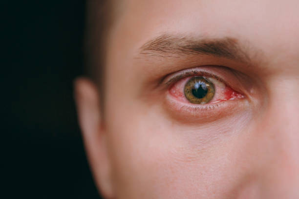 Intraocular Lymphoma Treatment Market by Types (Vitreoretinal, Uveal), Drug Class (Methotrexate, Cisplatin), End User (Hospitals, Specialty Centers) – Global Outlook & Forecast 2023-2031