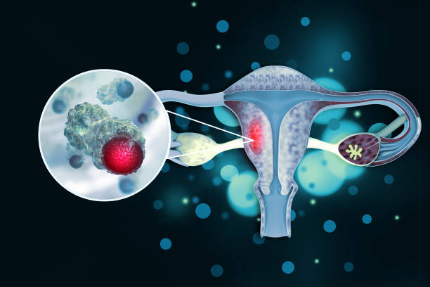 Endometrial Cancer Therapeutics Market by Type of Cancer (Endometrioid Adenocarcinoma, Uterine Sarcoma), Type of Therapy (Immunotherapy, Chemotherapy) – Global Outlook & Forecast 2023-2031